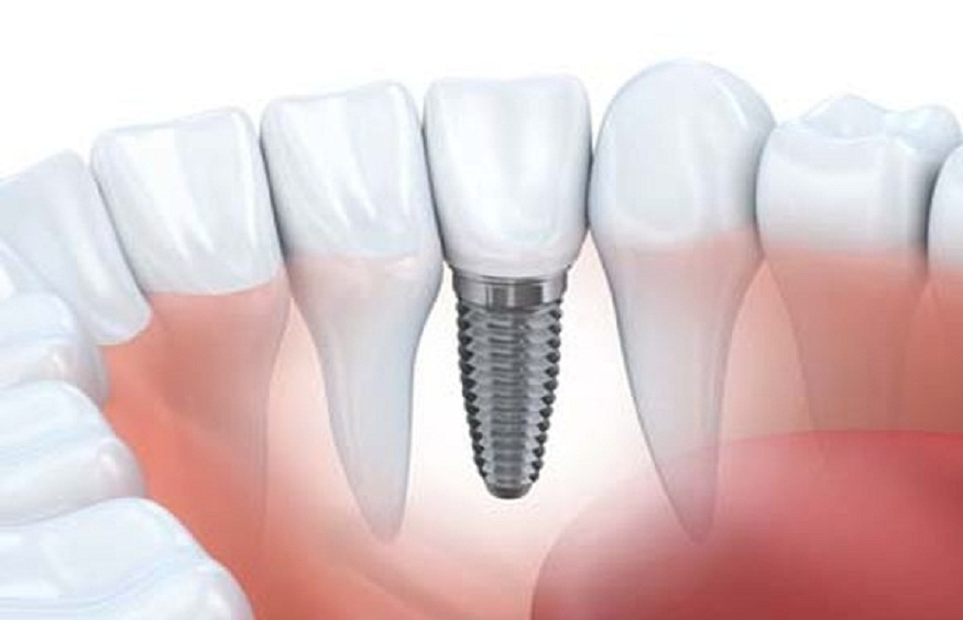 Tooth Replacement Options For Seniors: What Are The Best Choices?