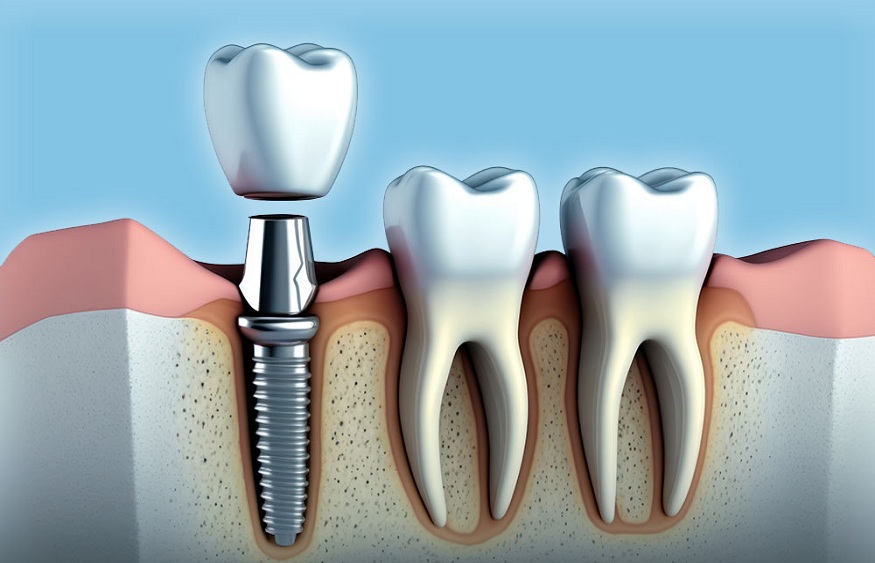 What are Some of the Overall Health Benefits of Dental Implants?