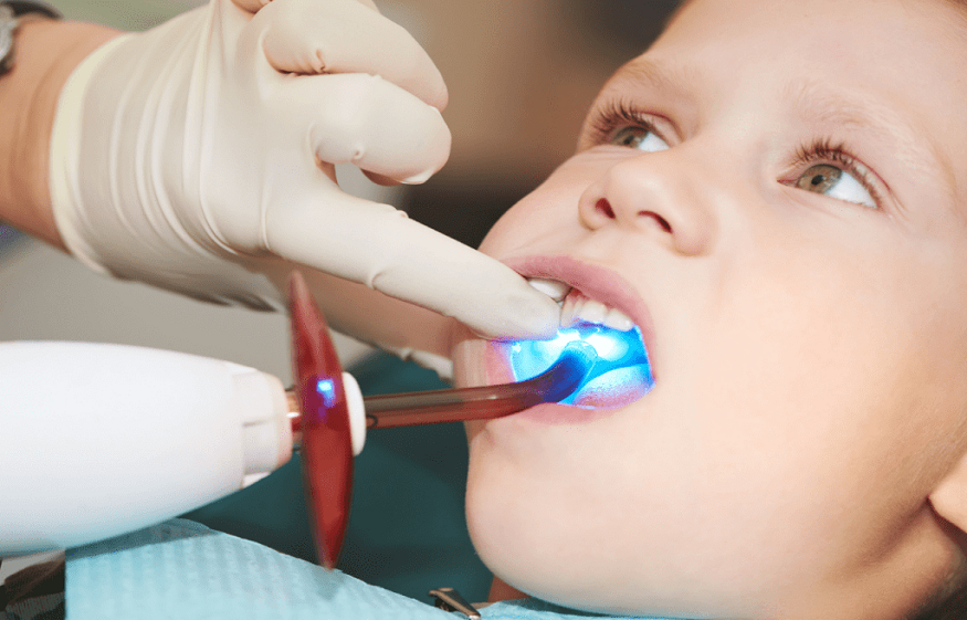 Dental Sealants for Children